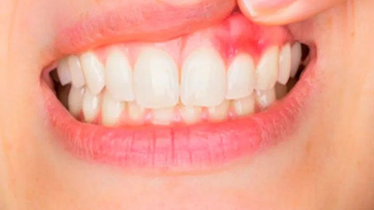 Early Signs of Gum Disease